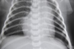hernia-diafragmatica-congenita-hdc-bochdalek-latero-posterior-izq-postop-1985-000