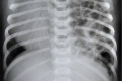 hernia-diafragmatica-congenita-hdc-bochdalek-latero-posterior-izq-postop-1985-001