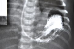 hernia-diafragmatica-congenita-hdc-bochdalek-posterior-izq-subclinica-herniacion-gastrica-19d1m-fractura-clavicula-izq-1986-000