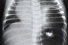 hernia-diafragmatica-congenita-hdc-bochdalek-posterior-izq-subclinica-herniacion-gastrica-19d1m-fractura-clavicula-izq-1986-002