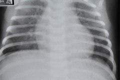 hernia-diafragmatica-congenita-hdc-bochdalek-posterior-izq-subclinica-herniacion-gastrica-19d1m-fractura-clavicula-izq-1986-004