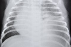 hernia-diafragmatica-congenita-hdc-bochdalek-posterior-izq-subclinica-herniacion-gastrica-19d1m-fractura-clavicula-izq-1986-005