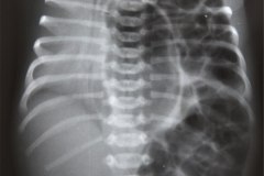 hernia-diafragmatica-congenita-hdc-bochdalek-total-izq-1989-000