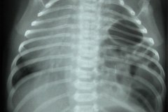 hernia-diafragmatica-congenita-hdc-morgagni-anterior-izq-1988-001
