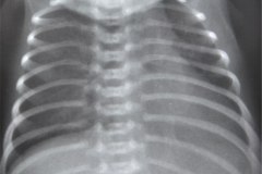 hernia-diafragmatica-congenita-hdc-morgagni-anterior-izq-postop-1991-000