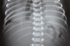 hernia-diafragmatica-congenita-hdc-morgagni-centro-anterior-1999-000