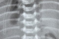 hernia-diafragmatica-congenita-hdc-morgagni-centro-anterior-1999-001