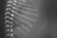 hernia-diafragmatica-congenita-hdc-morgagni-centro-anterior-1999-002