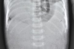 hernia-diafragmatica-congenita-hdc-morgagni-centro-anterior-izq-hipoplasia-pulmonar1984-000