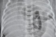hernia-diafragmatica-congenita-hdc-morgagni-centro-anterior-izq-hipoplasia-pulmonar1984-001