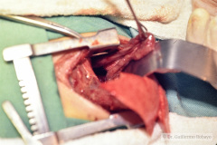 hernia-diafragmatica-correccion-14d-1992-002