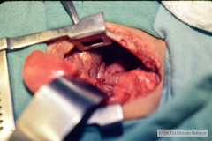 hernia-diafragmatica-correccion-14d-1992-006