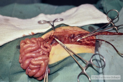 hernia-diafragmatica-correccion-14d-1992-009