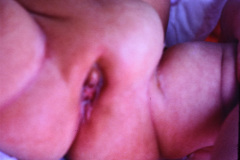 hernia-inguinal-izq-1986-000