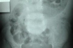 hernia-umbilical-1988-001