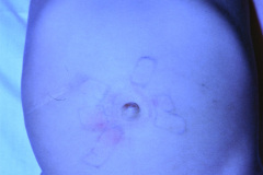 hernia-umbilical-con-signos-de-esparadrapo-000
