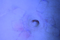 hernia-umbilical-con-signos-de-esparadrapo-002