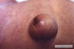 hernia-umbilical-granuloma-000