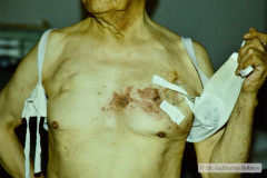 herpes-zoster-adulto-1980-000