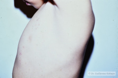 herpes-zoster-000