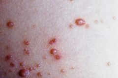 herpes-zoster-001
