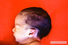hidrocefalia-1988_05-004