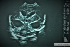 hidrocefalia-cavum-septum-pellucidum-vergae-ecografia-1991-000