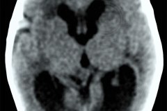 hidrocefalia-cavun-septum-pellucidum-plejo-coroideo-ecografia-2000-002