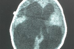 hidrocefalia-con-valvula-de-derivacion-tac-000