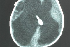 hidrocefalia-con-valvula-de-derivacion-tac-001