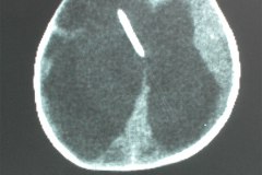 hidrocefalia-con-valvula-de-derivacion-tac-002
