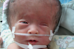 hidrocefalia-conjuntivitis-2011-02-16-000