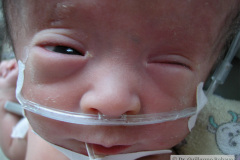 hidrocefalia-conjuntivitis-2011-02-16-002