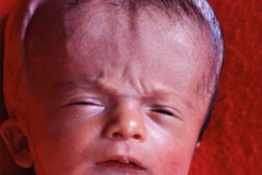 hidrocefalia-derivacion-venticulo-peritoneal-dvp-1987-000