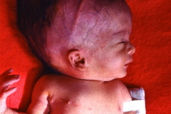 hidrocefalia-derivacion-venticulo-peritoneal-dvp-1987-001
