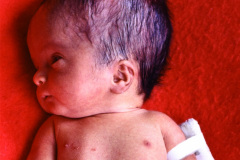 hidrocefalia-derivacion-venticulo-peritoneal-dvp-1987-004