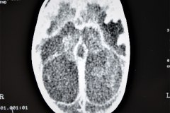 hidrocefalia-encefalomalacia-secuela-posthemorragica-2d8d-1996-002