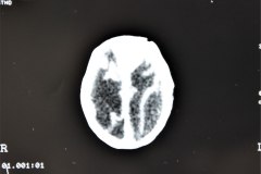 hidrocefalia-encefalomalacia-secuela-posthemorragica-2d8d-1996-009