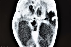 hidrocefalia-encefalomalacia-secuela-posthemorragica-2d8d-1996-020