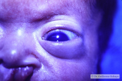 hidrocefalia-hipertension-endocraneal-exoftalmus-glaucoma-labio-hendico-izq-linea-palmar-unica-001
