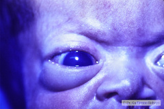hidrocefalia-hipertension-endocraneal-exoftalmus-glaucoma-labio-hendico-izq-linea-palmar-unica-009