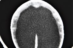 hidrocefalia-mielomeningocele-arnold-chiari-ii-1994-000