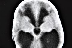hidrocefalia-mielomeningocele-arnold-chiari-ii-1994-005