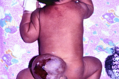 hidrocefalia-mielomeningocele-lumbar-1994-000