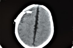 hidrocefalia-mielomeningocele-y-post-dvp-tac-2001-010