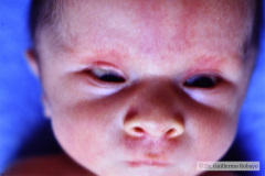 hidrocefalia-ojos-en-sol-poniente-endotropia-transiluminacion-004