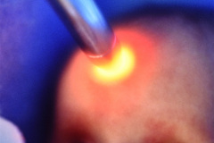 hidrocefalia-ojos-en-sol-poniente-endotropia-transiluminacion-005