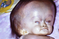 hidrocefalia-ojos-en-sol-poniente-ulceras-de-presion-cefalicas-005