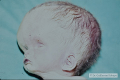 hidrocefalia-por-citomegalovirus-cmv-001