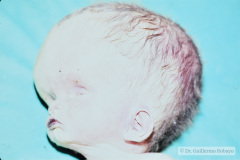 hidrocefalia-por-citomegalovirus-cmv-002